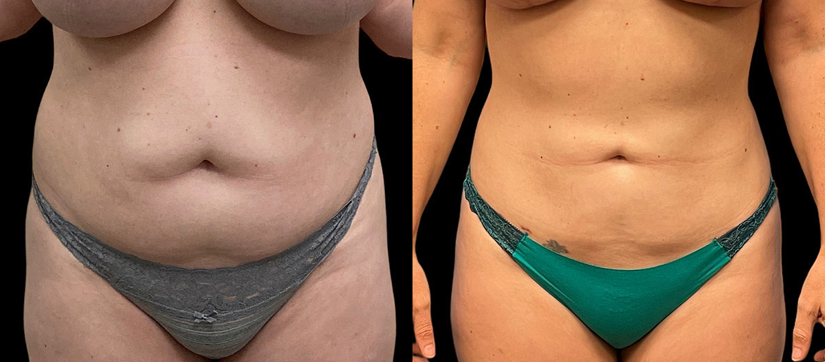 vaser liposuction before and after patient at Jacobson Plastic Surgery located in Beverly Hills, CA